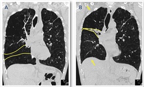 BLVR before and after images demonstrating lung volume reduction