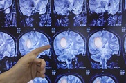 Penn neurosurgeon pointing at glioblastoma on brain scan.