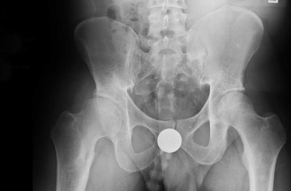 X-ray of hip