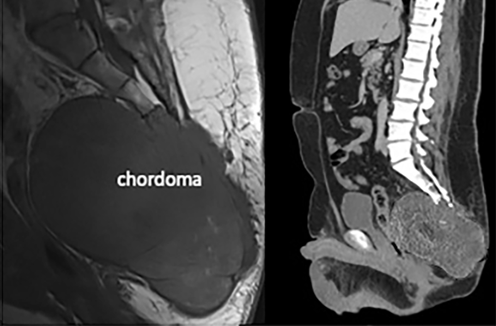 https://www.pennmedicine.org/-/media/documents%20and%20audio/articles/clinical%20briefings/2022/october/sacral_chordoma_figure1.ashx