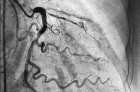 CT scan demonstrates left anterior descending coronary artery occlusion