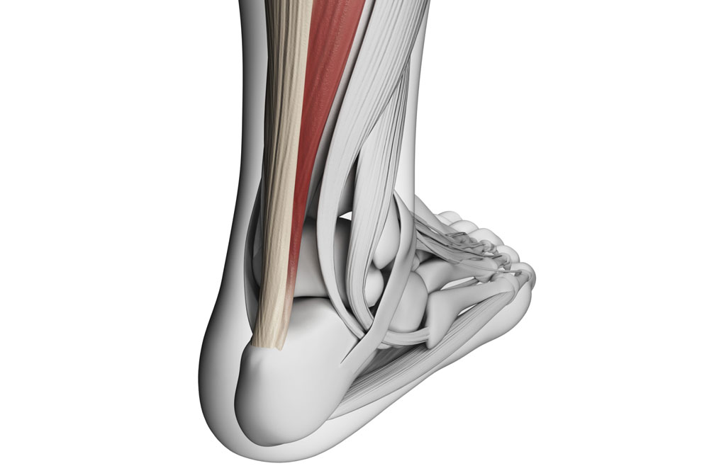 Achilles Tendonitis - Symptoms and Causes