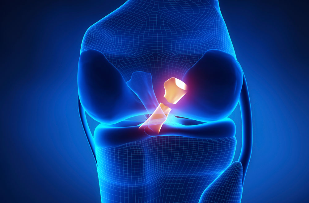 Posterior Cruciate Ligament Injury (PCL) - Symptoms and Causes