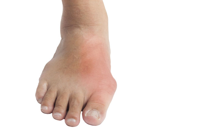 What Is Gout In Foot