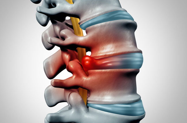 Herniated Disc - Symptoms and Causes