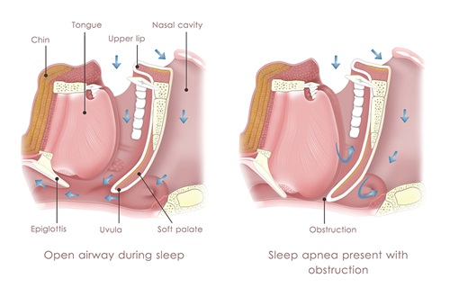 Advice to Help you Sleep After Joint Surgery - Puget Sound Orthopaedics