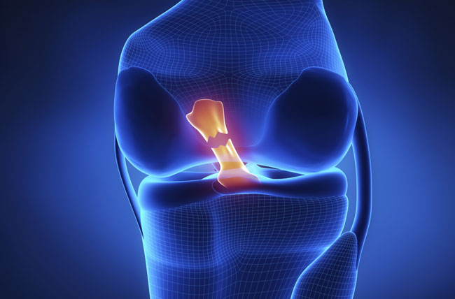 Anterior Cruciate Ligament Injury (ACL) - Symptoms and Causes