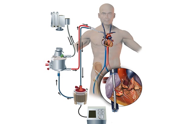 Figure demonstrating process of extracorporeal mechanical oxygenation