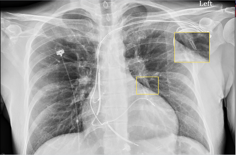 CARDIOMEMS: Pulmonary Artery Pressure Monitoring in ...