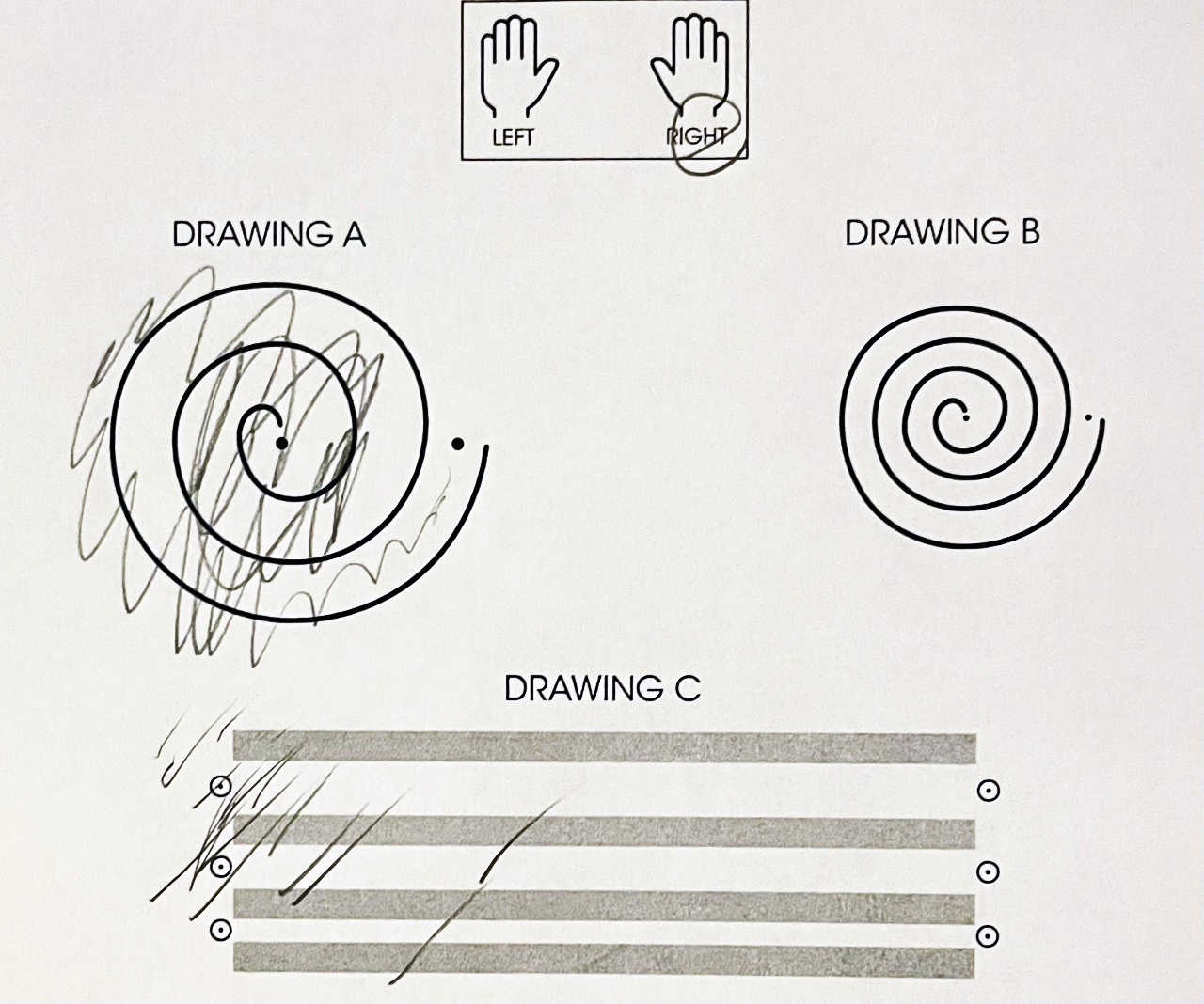 A printed spiral copied by hand before treatment to test the effect of a patients essential tremor