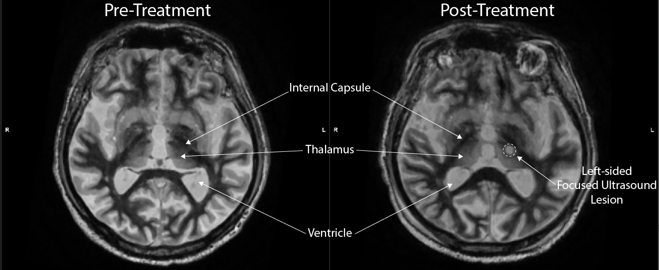 The brain of a patient with essential tremor before and after treatment