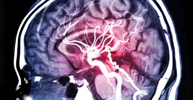 Do You Know the Basics About Brain Aneurysms? – Penn Medicine