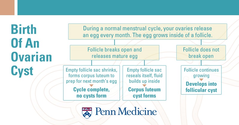 Ovarian Cysts 101 - Penn Medicine