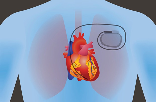 Cartoon of a pacemaker inside of someone