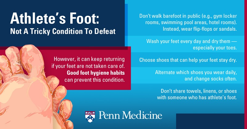 Athlete’s Foot: Not Just for Athletes - Penn Medicine
