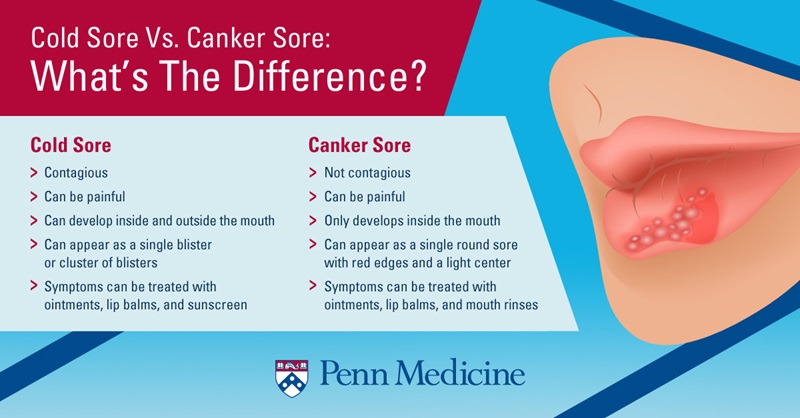Cold Sores Vs Canker Sores What Are They And How Do I Get Rid Of